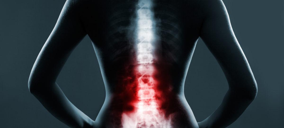 Nadwyrężanie kręgosłupa przyczyną powstawania bólu garbienie się